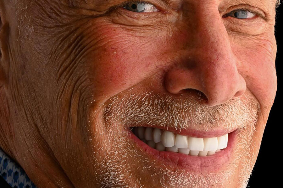 Fixed, full mouth dental implants patient post surgery with Marsh Cove Dental & Implant Center