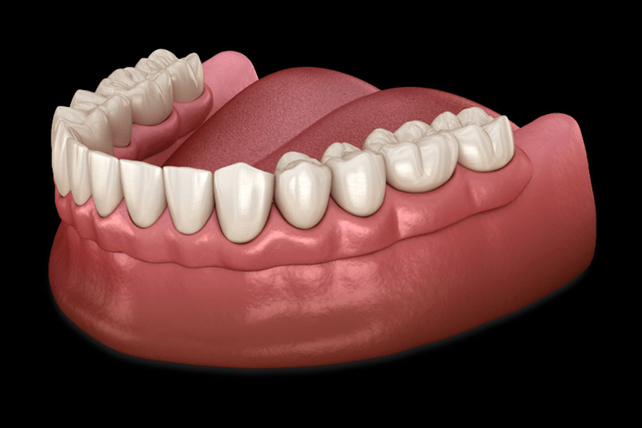 Traditional Dentures depicting the different options available between fixed & removable teeth replacements from Marsh Cove Dental & Implant Center